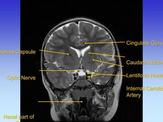 Internal Capsule Optic Nerve Nasal part of Pharynx 
Cingulate Gyrus 
Caudate Nucleus 
Lentiform Nucleus 
Internal Carotid 
Artery 
 