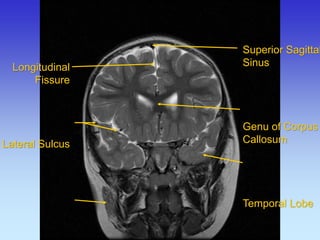Longitudinal Fissure Lateral Sulcus Superior Sagittal 
Sinus 
Genu of Corpus 
Callosum 
Temporal Lobe  