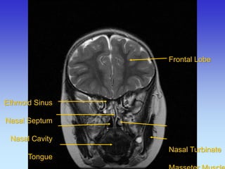 Ethmoid Sinus Nasal Septum Nasal Cavity Tongue 
Frontal Lobe Nasal Turbinate Masseter Muscle  