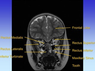 Rectus Medialis 
Rectus Lateralis 
Inferior Turbinate 
Frontal Lobe Rectus Superior Rectus Inferior Maxillary Sinus Tooth  