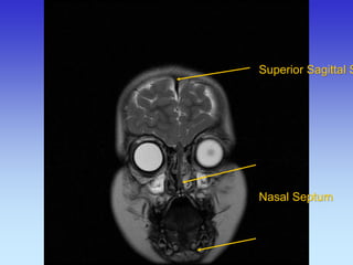 Superior Sagittal Sinus Nasal Septum  
