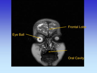 Eye Ball 
Frontal Lobe Oral Cavity  