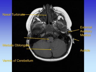 Nasal Turbinate Medulla Oblongata Vermis of Cerebellum 
External Auditory Meatus Auricle  