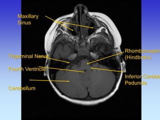 Maxillary Sinus 
Trigeminal Nerve 
Fourth Ventricle 
Cerebellum 
Rhombencephalon (Hindbrain) Inferior Cerebellar Peduncle  