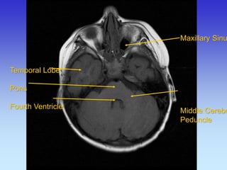 Temporal Lobe 
Pons 
Fourth Ventricle 
Maxillary Sinus Middle Cerebellar Peduncle  