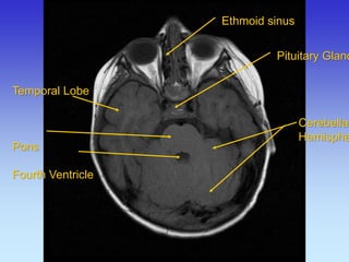 Temporal Lobe 
Pons 
Fourth Ventricle 
Ethmoid sinus 
Cerebellar 
Hemisphere 
Pituitary Gland  