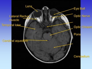 Lens 
Cerebral aqueduct 
Eye Ball 
Optic Nerve 
Optic Chiasm 
Pons 
Cerebellum 
Temporal lobe 
Lateral Rectus 
muscle  
