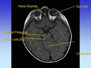 Nasal Septum 
Cerebral Peduncle 
Inferior colliculus 
Eye Ball Cerebellum  