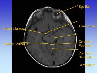 Eye Ball Third Ventricle Cerebral Peduncle Vermis of Cerebellum Cerebellum 
Hypothalamus Inferior Colliculus  
