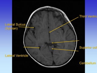 Third Ventricle Superior colliculus Cerebellum 
Lateral Sulcus (Sylvian) Lateral Ventricle  