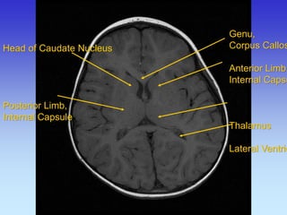 Head of Caudate Nucleus Posterior Limb, Internal Capsule 
Genu, 
Corpus Callosum 
Anterior Limb, 
Internal Capsule 
Thalamus 
Lateral Ventricle  