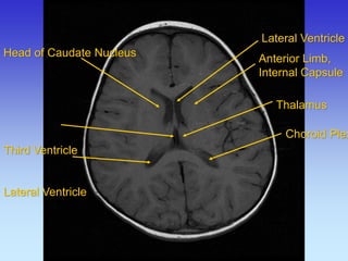 Choroid Plexus 
Lateral Ventricle 
Anterior Limb, Internal Capsule 
Thalamus 
Head of Caudate Nucleus Third Ventricle Lateral Ventricle  