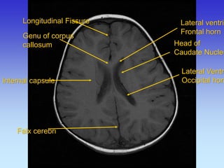 Longitudinal Fissure 
Genu of corpus callosum 
Internal capsule 
Falx cerebri 
Lateral ventricle, 
Frontal horn 
Head of Caudate Nucleus 
Lateral Ventricle, 
Occipital horn  