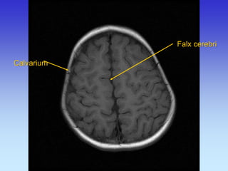 Calvarium 
Falx cerebri  