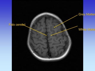 Grey Matter White Matter 
Falx cerebri  