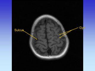 Sulcus 
Gyri  
