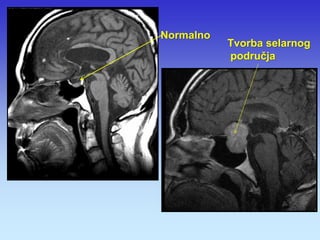 Normalno 
Tvorba selarnog područja  