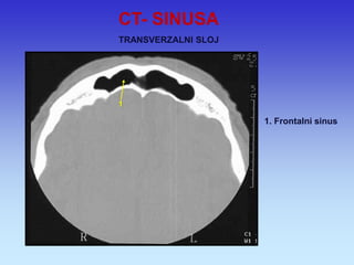 1 
1. Frontalni sinus 
CT- SINUSA 
TRANSVERZALNI SLOJ  