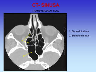 1. Etmoidni sinus 2. Sfenoidni sinus 
1 
2 
CT- SINUSA 
TRANSVERZALNI SLOJ  