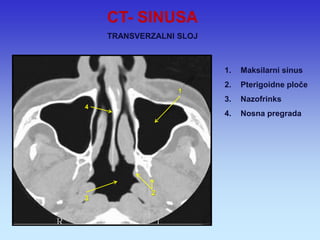 1.Maksilarni sinus 
2.Pterigoidne ploče 
3.Nazofrinks 
4.Nosna pregrada 
1 
2 
3 
4 
CT- SINUSA TRANSVERZALNI SLOJ  
