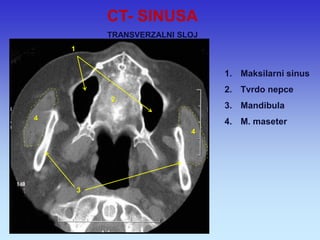 1.Maksilarni sinus 
2.Tvrdo nepce 
3.Mandibula 
4.M. maseter 
3 
2 
1 
3 
4 
4 
CT- SINUSA TRANSVERZALNI SLOJ  