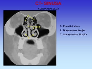 1. Etmoidni sinus 
2. Donja nosna školjka 
3. Srednjanosna školjka 
1 
2 
3 
CT- SINUSA KORONARNI SLOJ  