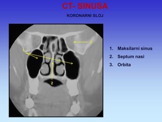 1.Maksilarni sinus 
2.Septum nasi 
3.Orbita 
1 
2 
3 
CT- SINUSA KORONARNI SLOJ  