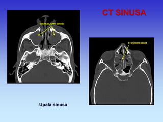 CT SINUSA 
Upala sinusa 
MMAKSILARNI SINUSI 
ETMOIDINI SINUS  
