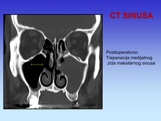 CT SINUSA 
Posttoperativno: Trepanacija medijalnog zida maksilarnog sinusa  