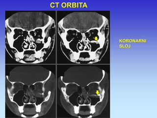 KORONARNI SLOJ 
CT ORBITA  