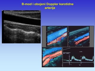 B-mod i obojeni Doppler karotidne arterije  