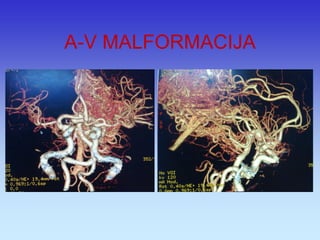 A-V MALFORMACIJA  