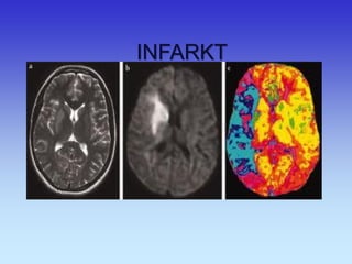 INFARKT  
