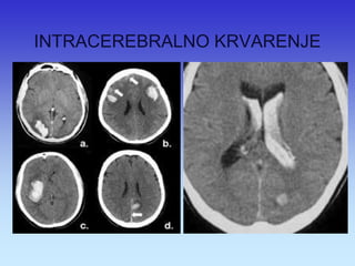 INTRACEREBRALNO KRVARENJE  