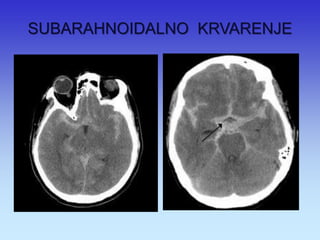 SUBARAHNOIDALNO KRVARENJE  