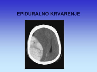 EPIDURALNO KRVARENJE  