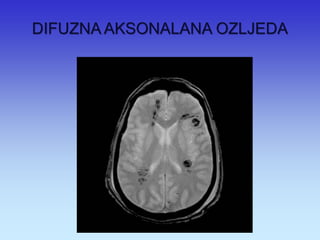 DIFUZNA AKSONALANA OZLJEDA 