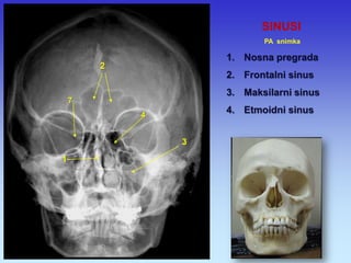 SINUSI PA snimka 
1.Nosna pregrada 
2.Frontalni sinus 
3.Maksilarni sinus 
4.Etmoidni sinus 
2 
1 
4 
3 
7  
