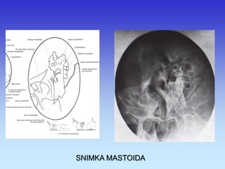 SNIMKA MASTOIDA 
 