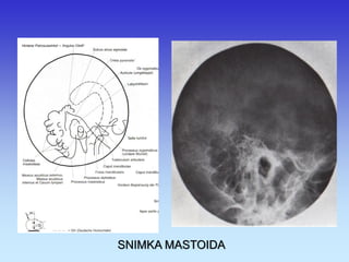 SNIMKA MASTOIDA 
 