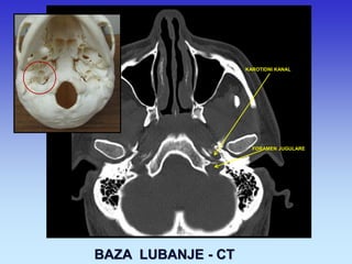 BAZA LUBANJE - CT 
KAROTIDNI KANAL 
FORAMEN JUGULARE  