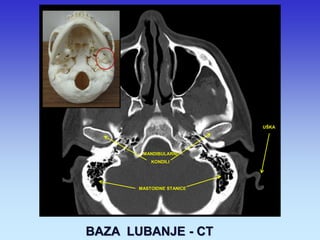 MANDIBULARNI 
KONDILI 
MASTOIDNE STANICE 
UŠKA 
BAZA LUBANJE - CT  