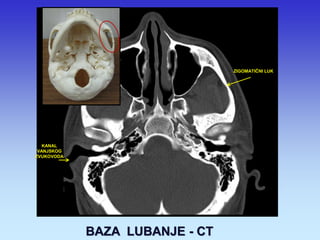 ZIGOMATIČNI LUK 
KANAL VANJSKOG ZVUKOVODA 
BAZA LUBANJE - CT  