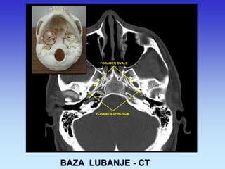 FORAMEN OVALE 
FORAMEN SPINOSUM 
BAZA LUBANJE - CT  