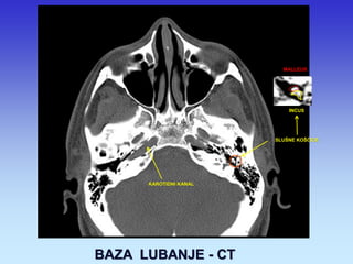 KAROTIDNI KANAL 
SLUŠNE KOŠĆICE 
MALLEUS 
INCUS 
BAZA LUBANJE - CT  