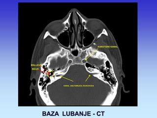 KANAL UNUTARNJEG ZVUKOVODA 
KAROTIDNI KANAL 
MALLEUS INCUS 
BAZA LUBANJE - CT  