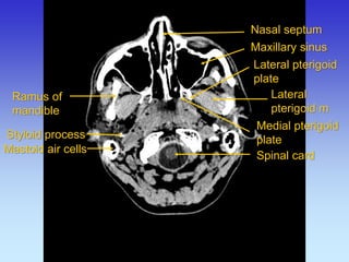 Ramus of mandible 
Lateral pterigoid m 
Lateral pterigoid plate 
Medial pterigoid plate 
Maxillary sinus 
Nasal septum 
Mastoid air cells 
Spinal card 
Styloid process  