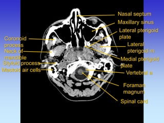 Coronoid process 
Neck of mandible 
Lateral pterigoid m 
Lateral pterigoid plate 
Medial pterigoid plate 
Maxillary sinus 
Nasal septum 
Mastoid air cells 
Styloid process 
Spinal card 
Foraman magnum 
Vertebral a  