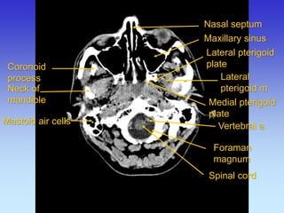 Coronoid process 
Neck of mandible 
Mastoid air cells 
Lateral pterigoid m 
Lateral pterigoid plate 
Medial pterigoid plate 
Maxillary sinus 
Nasal septum 
Spinal cord 
Foraman magnum 
Vertebral a  