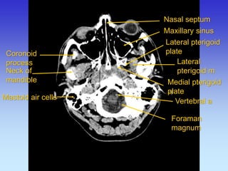 Coronoid process 
Neck of mandible 
Lateral pterigoid m 
Lateral pterigoid plate 
Medial pterigoid plate 
Maxillary sinus 
Nasal septum 
Mastoid air cells 
Foraman magnum 
Vertebral a  